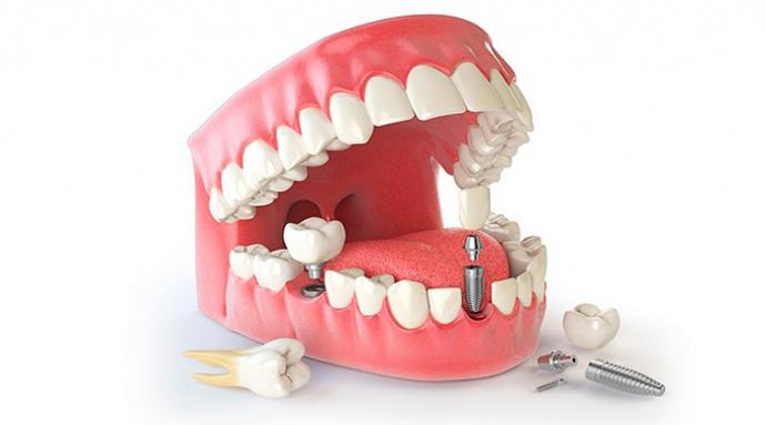 что такое зубной имплант