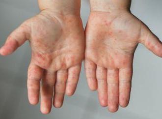 Інфекційні хвороби