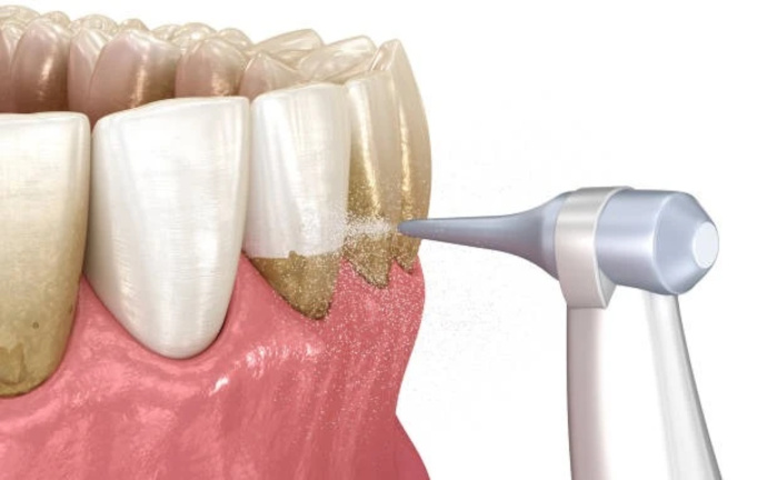 чистка зубів