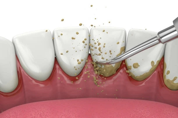 професійна чистка зубів